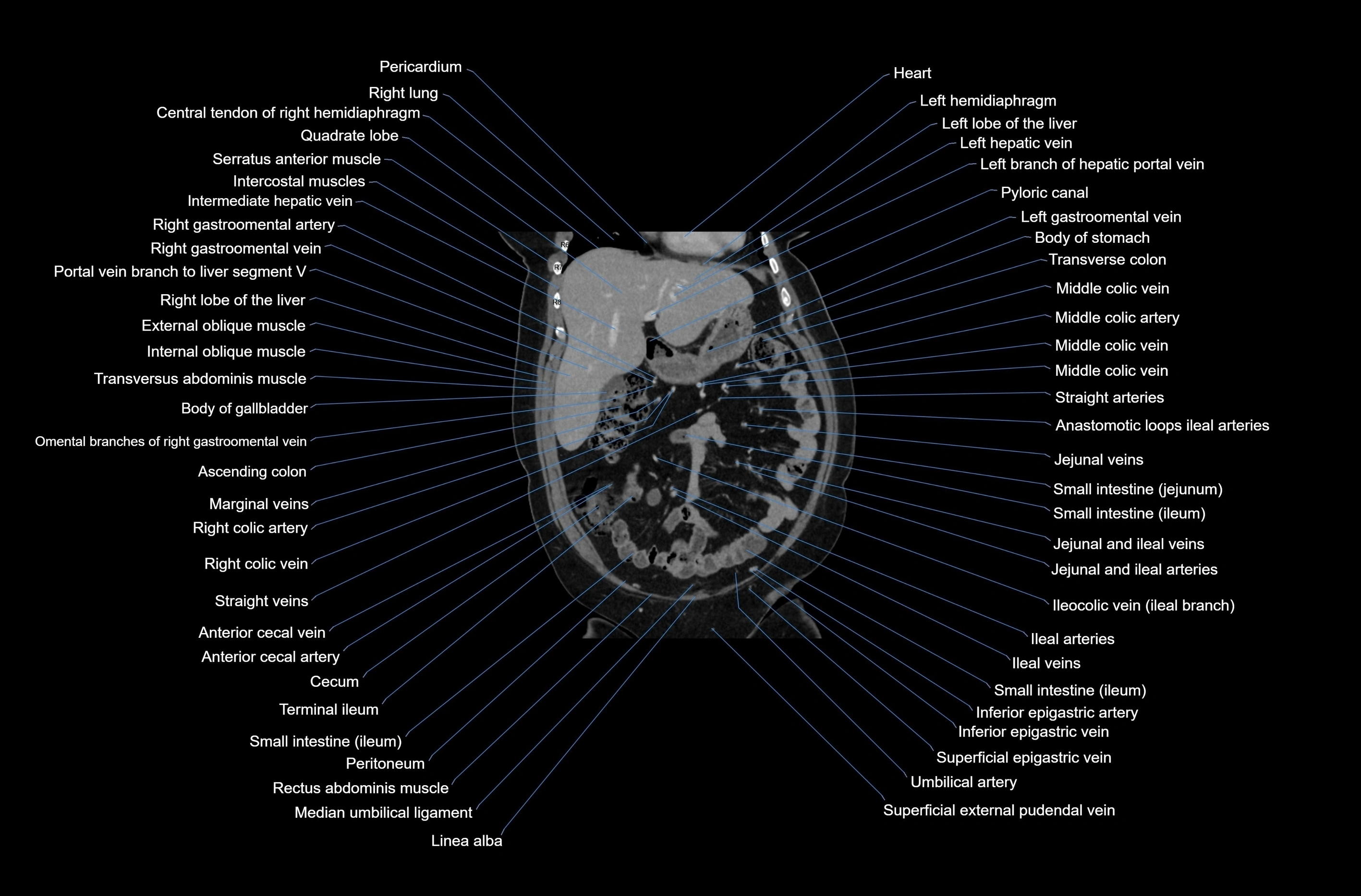 CT abdomen coronal cross sectional anatomy labelled radiology image-00026.webp